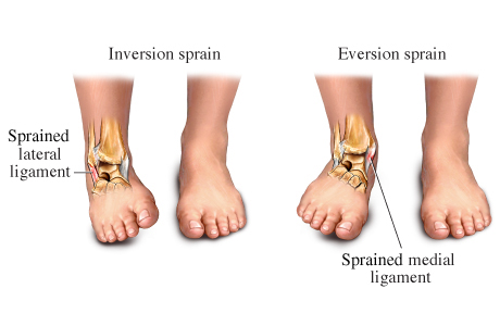 ankle sprains sprain